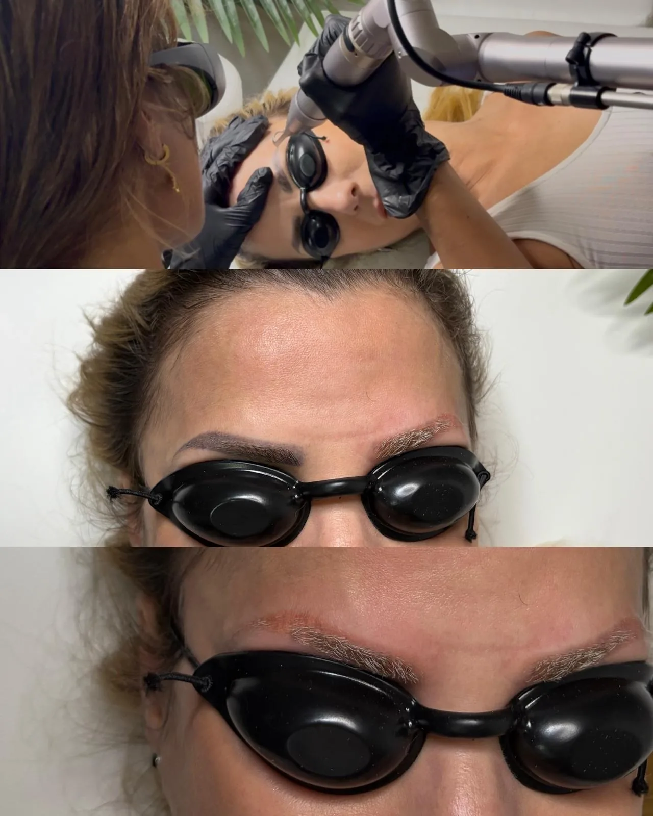 Détatouage de microblading — sourcils avant et après 4 séances de laser picoseconde